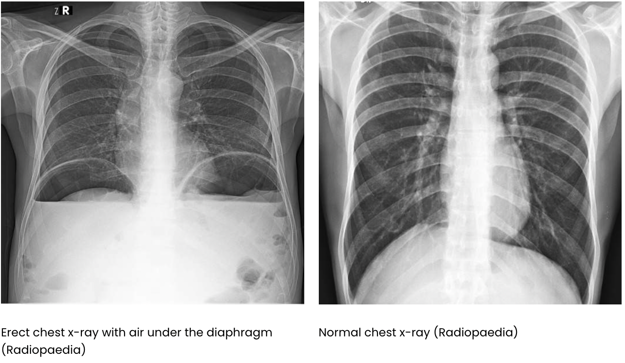 <p><span>Free air under the diaphragm may suggest a possible perforation of the bowel (either stomach or gut as they hold air in these spaces) and this can&nbsp;lead to air leaking out and building up under the diaphragm.</span></p><p><span>There is also possible duodenal ulcers or peptic-duodenal ulcers which may also possibly be the cause of this.</span></p><p><span>Free air is example of pneuomoperitoneum.</span></p><p><span>The diagram of the X-ray shows how air build up under the diaphragm causes air to push up against arched diaphragm and flattens the muscle. </span></p>