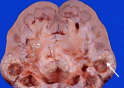 <p>What pathology is indicated by this image? What is indicated at the tip of the white arrow?</p>