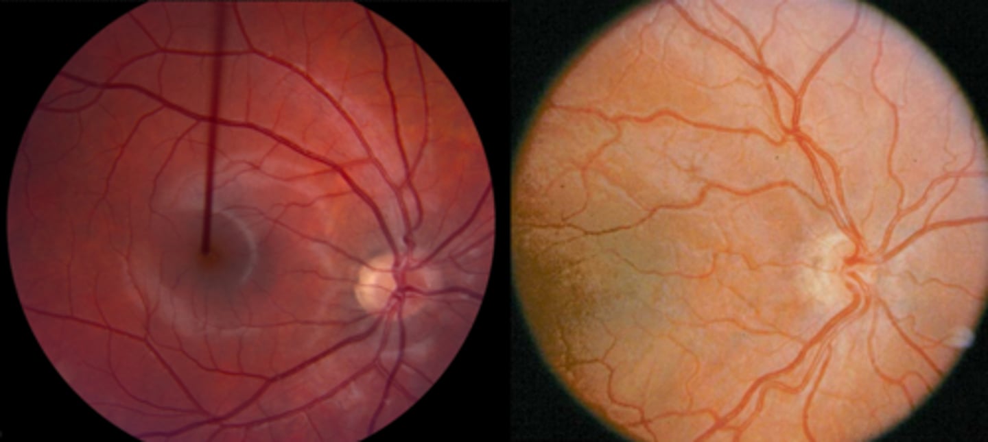 <p>hypoplastic ONH – vessels seem out of proportion to the size of the ONH</p>
