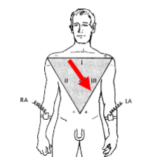 <p><span>The average direction in which the dipole causing the QRS complex is oriented</span></p><p><span>Usually lies within the 0 º to 90 º quadrant down and to the left.</span></p><p><span>It corresponds to the anatomical pathway the wave of depolarisation takes</span></p>