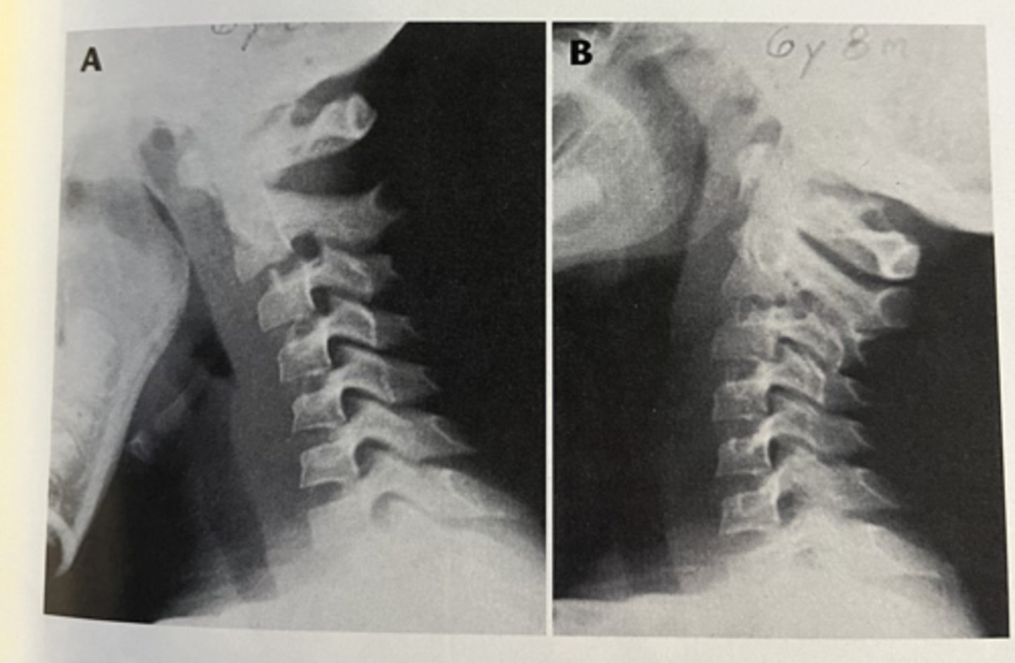 <p>neck pain often s/p MVA</p><p>may be anatomic variant in adolescents due to ligamentous laxity</p><p>seen on XR with subluxation of vertebral body that would be accentuated with flexion</p>