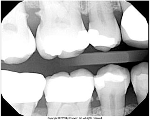 <ul><li><p>Bacteria</p></li><li><p>Plaque</p></li><li><p>Decay</p></li><li><p>Rough surfaces on teeth</p></li><li><p>Restorations with overhanging margins</p></li><li><p>Build-up of calculus</p></li></ul><p></p>