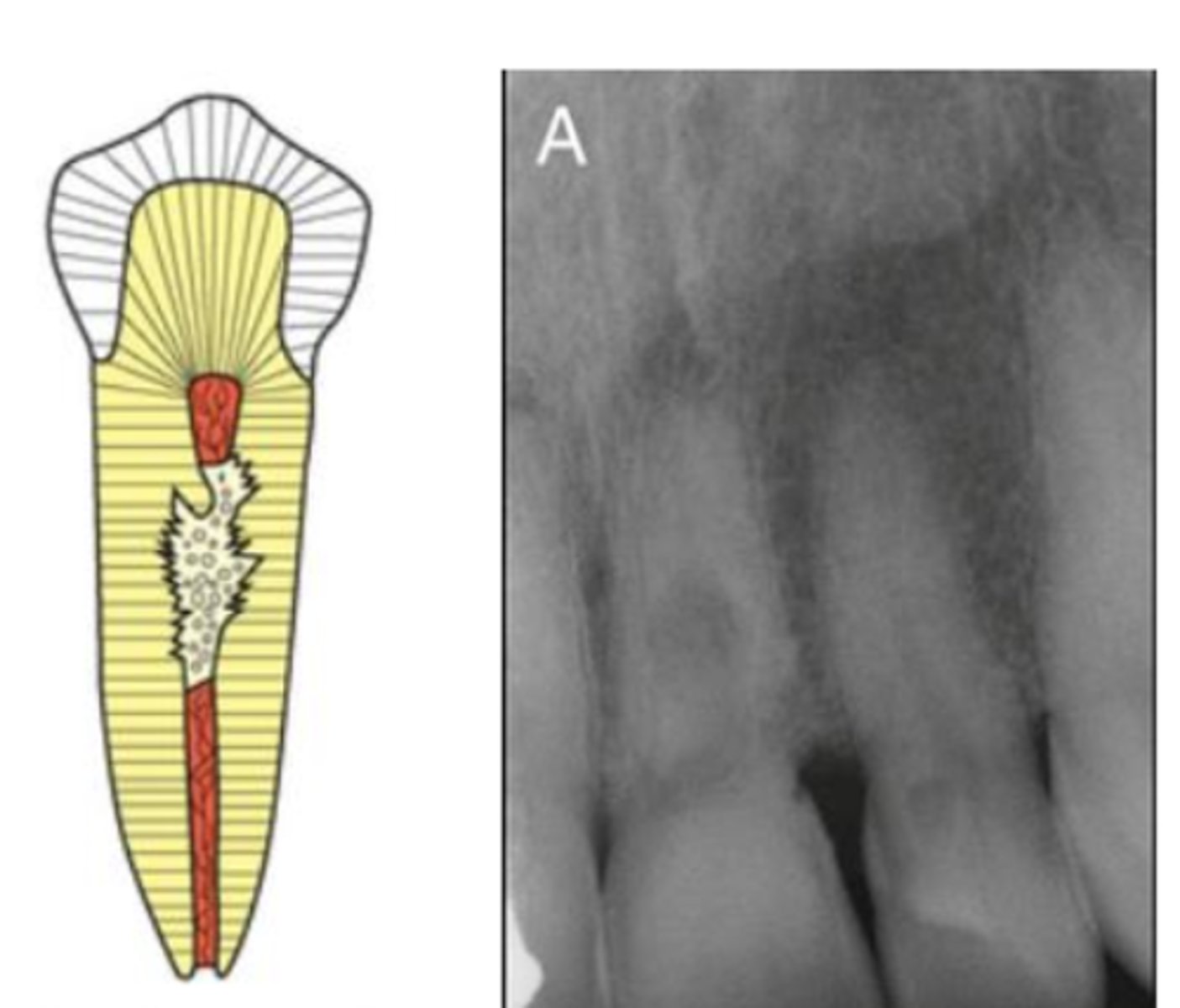 <p>What type of resorption?</p>