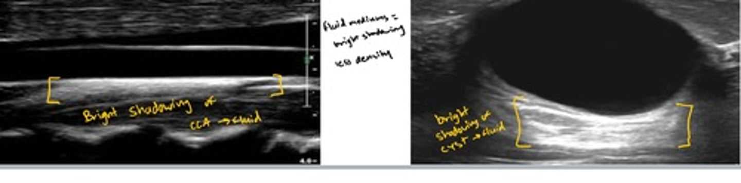 <p>When ultrasound passes through a fluid medium, the intensity of the sound energy is not diminished. Tissue behind the fluid collection are more echogenic (brighter because there is more acoustic power to reflect back to the transducer)</p><p>Ex://sound travels easily through liquid, such as cysts or bladder. The area behind the fluid looks brighter because the ultrasound energy didn't get absorbed. A simple cyst in the liver or breast is a classic example, appearing black in the center with a brightly lit area immediately behind it.</p>