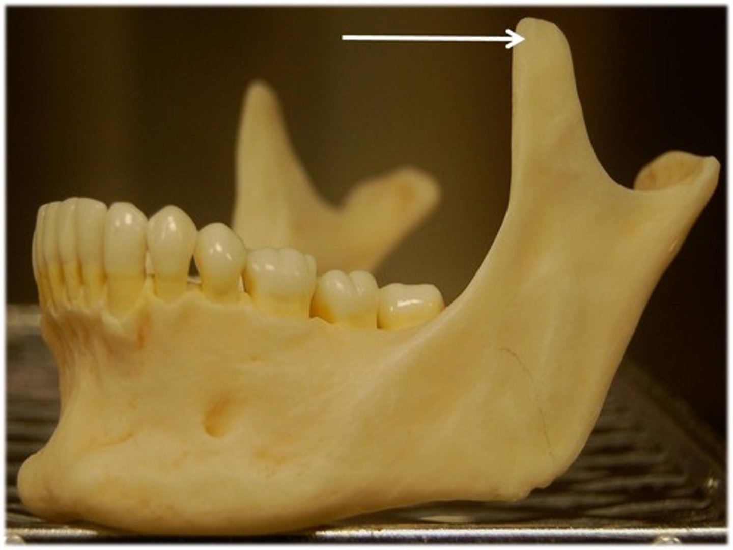 <p>Name this part of the mandible</p>