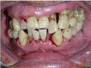 <p><span>Bone loss has occurred due to unstopped gingivitis.&nbsp; Teeth may appear longer. There may be spaces between teeth that were not there before. Teeth may become loose.&nbsp; Plaque and tartar may be visible.&nbsp; There can be draining pus. </span></p>