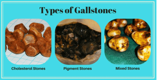<p>gallstones can vary in size from a grain of sand to the size of a large golf ball</p>
