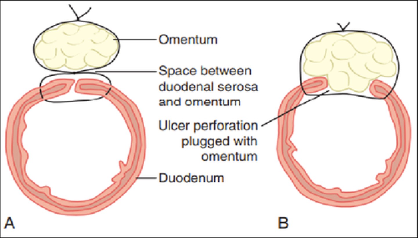 <p>mesenteric stem cells are used to heal rupture</p>