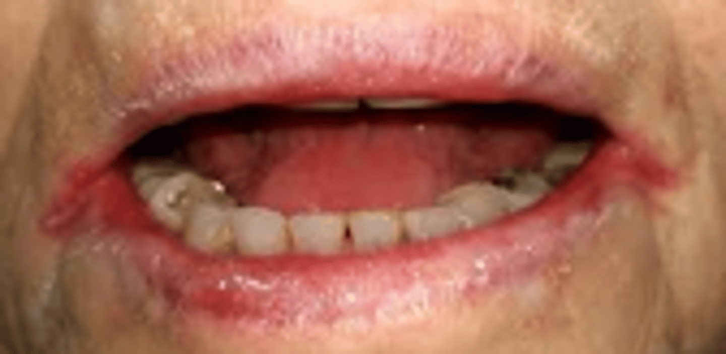 <p>maceration of the skin at the corners of the mouth</p>