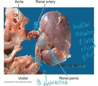 <p>Obstruction of urinary tract<br>→ can’t get rid of fluid<br>→ fluid backs up -→ increase pressure <br>→ dilation of renal pelvis + calyces<br>→ kidney tissue dmg + atrophy</p>