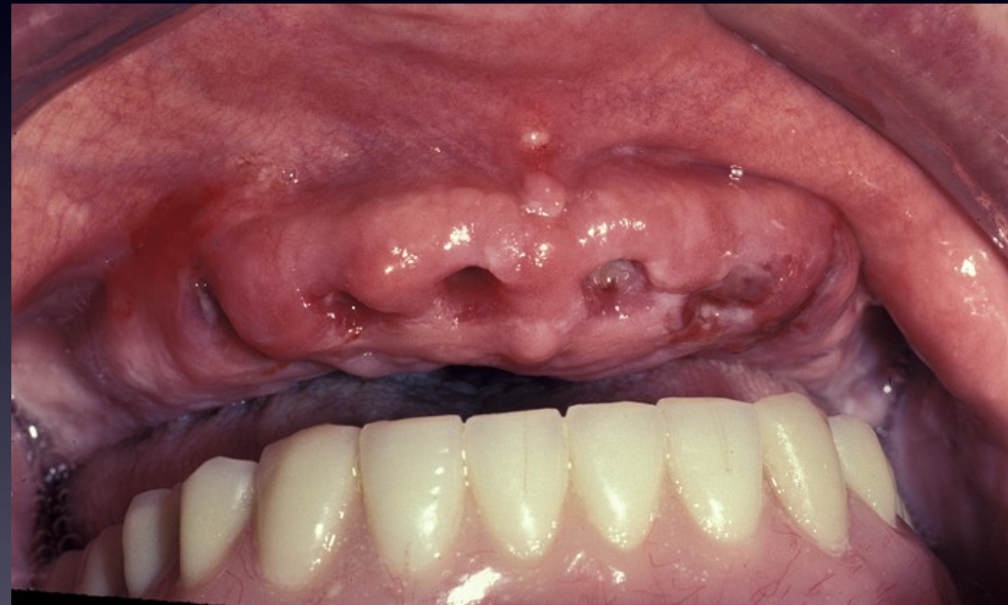 <p>Same as complete denture replaces inserted same day and same time as the pday they were extreacted</p>