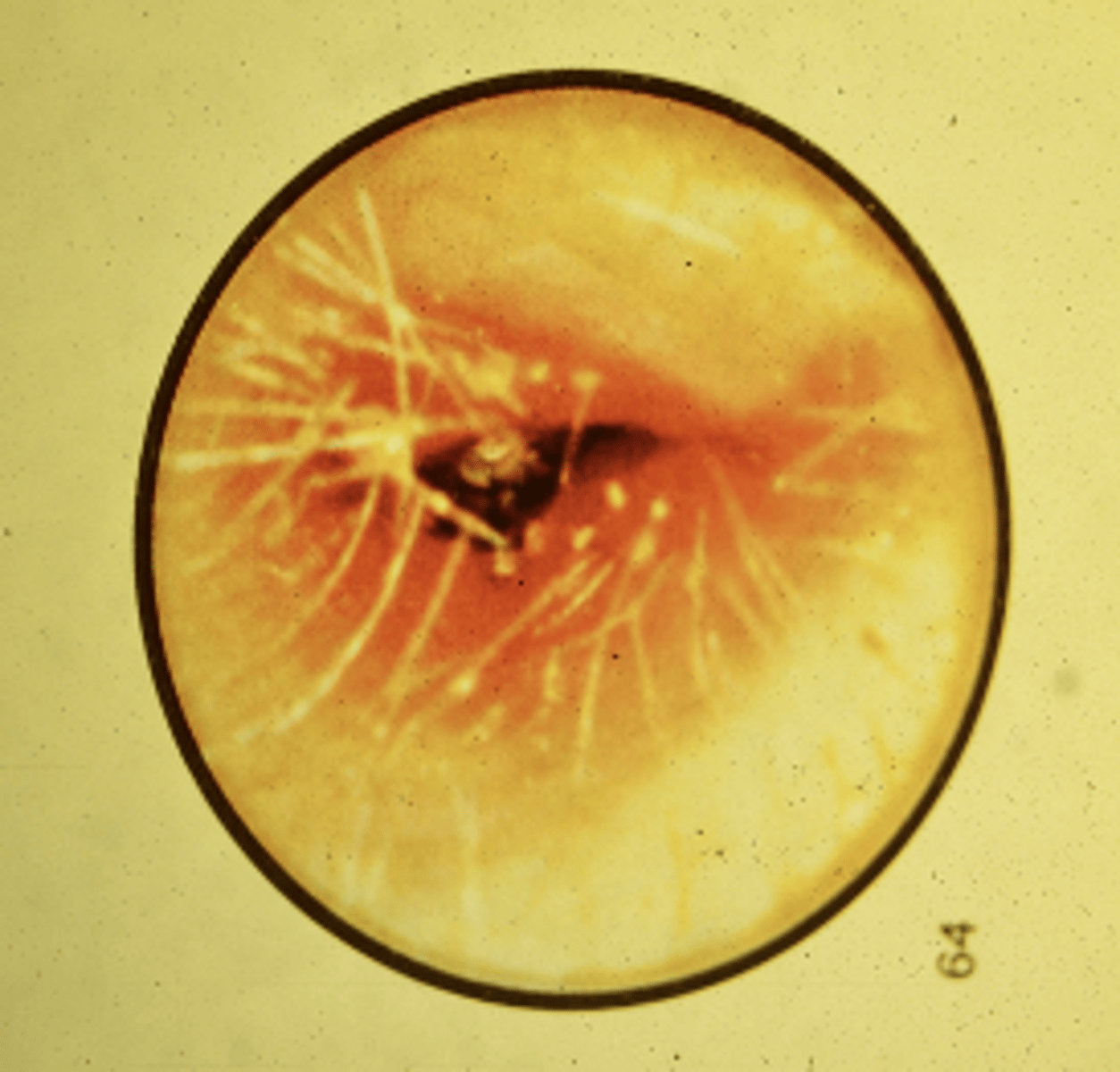 <p>-Agents: P. Aeruginosa; S. Aureus</p><p>-TX: Analgesics; topical- Cortisporin or Ofloxacin; Systemic- Phenoxymethyl PCN or Augmentin</p>