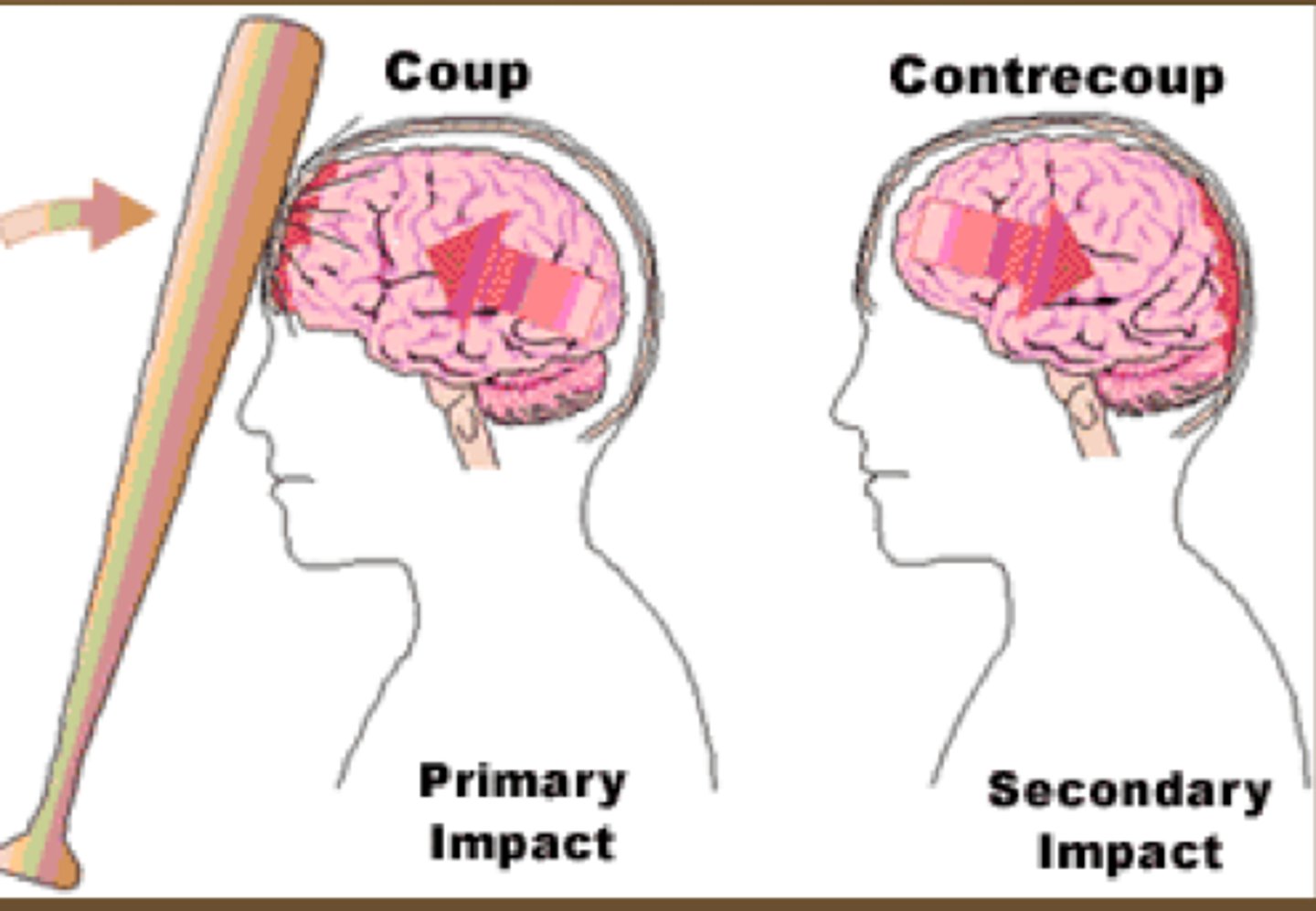 <p>Collision of the brain with the skull resulting in small vessel rupture, multiple microhemorrhages &amp; possible edema of the brain parenchyma</p>