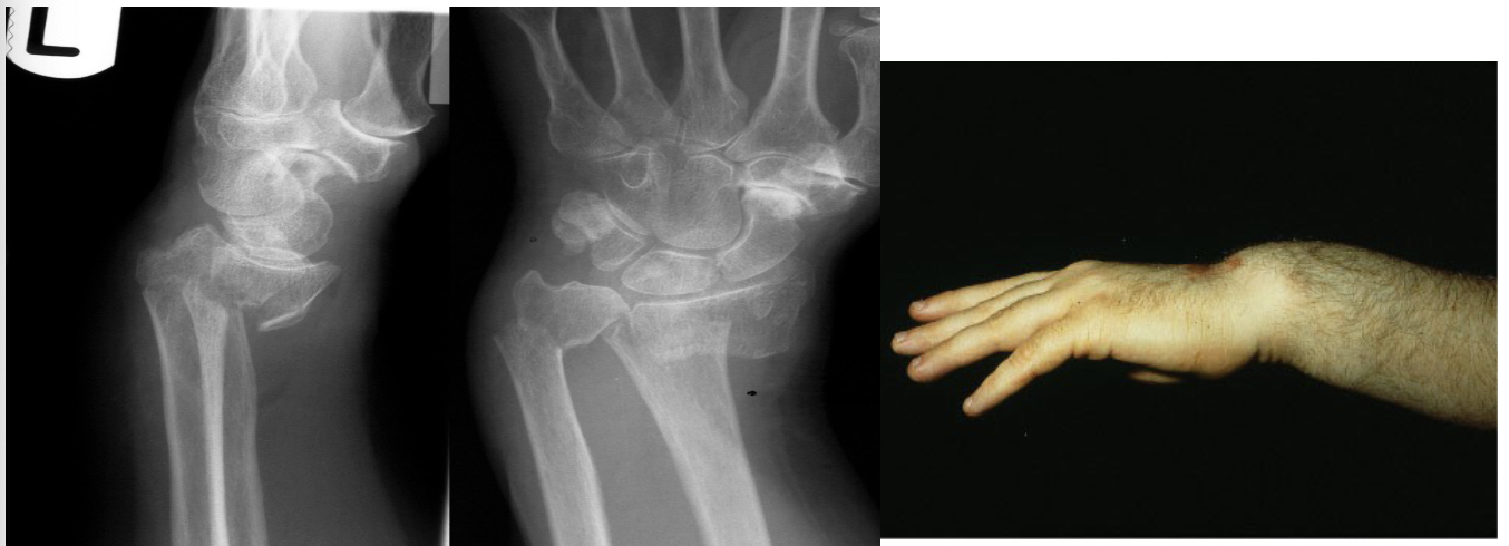 <p>Name this fracture</p>