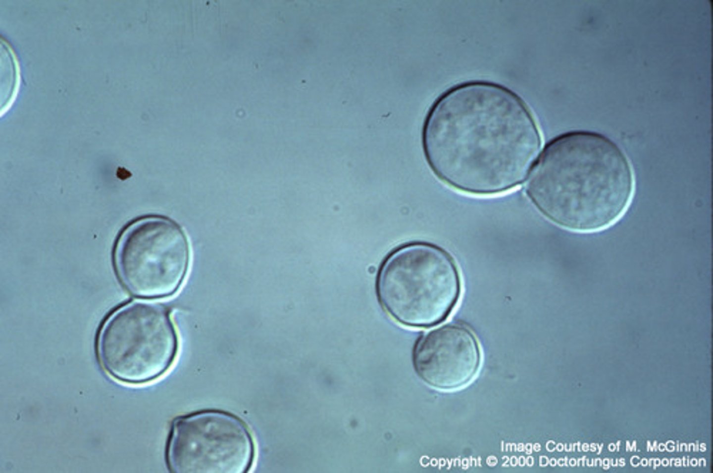<p>Blastomyces in general stuff:</p><p>-fungus endemic to Ohio and Mississippi River valleys, Great Lakes</p><p>-soil, decaying wood, rivers, lakes, recreational water</p><p>-inhalation of conidia</p><p>-could by asymptomatic, acute pneumonia, chronic pnuemia, or acute respiratory distress syndrome (ARDS)</p><p>-usually go systemic to skin, soft tissue, bone, etc</p><p>-cough, fever, SOB, night sweats, weight loss, non-healing skin lesions</p><p>-diagnose with bacterial pneumonia first but antibacterial agents don't work and then a fungal infection is considered</p><p>-50% asymptomatic and resolve without tx</p><p>-macro and micrscopic morphology used the most</p><p>DERM STUFF</p><p>-37C so LARGE yeast form they have thick, refractile, double-countoured cell walls, single broad based bud, they can even fold in on themselves a little bit. don't tend to break off until they are the size of the parent cell</p><p>-Mold form: in culture plate, filamentous mold with septated hyphae, short or long conidiophores, round/pear shaped conidia at the apex of conidiophore (lollipop), or directly from hyphae, need to differentiate from scedosporium (also lollipop)</p><p>-classic eastern 1/2 of the US</p><p>-very common in DOGS becuase they love to sniff the ground and then they spreada it to us.</p><p>COLONY MORPH: prickly and spiky usually means dimorphic.</p>