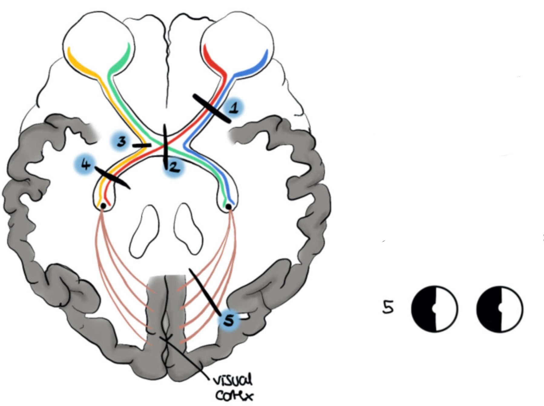 <p>What visual field defect is shown</p>