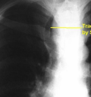 <p>trachea displaced</p>