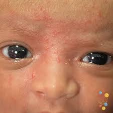 <p>erythema toxicum</p>