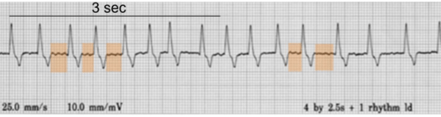 <p>Describe EKG</p>