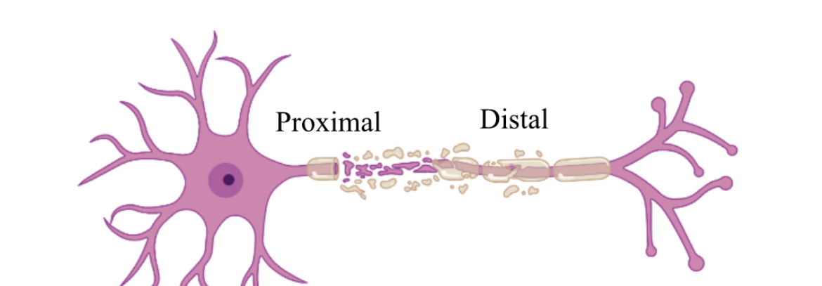 <ul><li><p>proximal retrograde - chromatolysis (reactive changes in the cell body or soma) , so cell body swells, nucleus migrates. </p></li><li><p>Distal anterograde - which is degeneration down the axon first. </p></li></ul>
