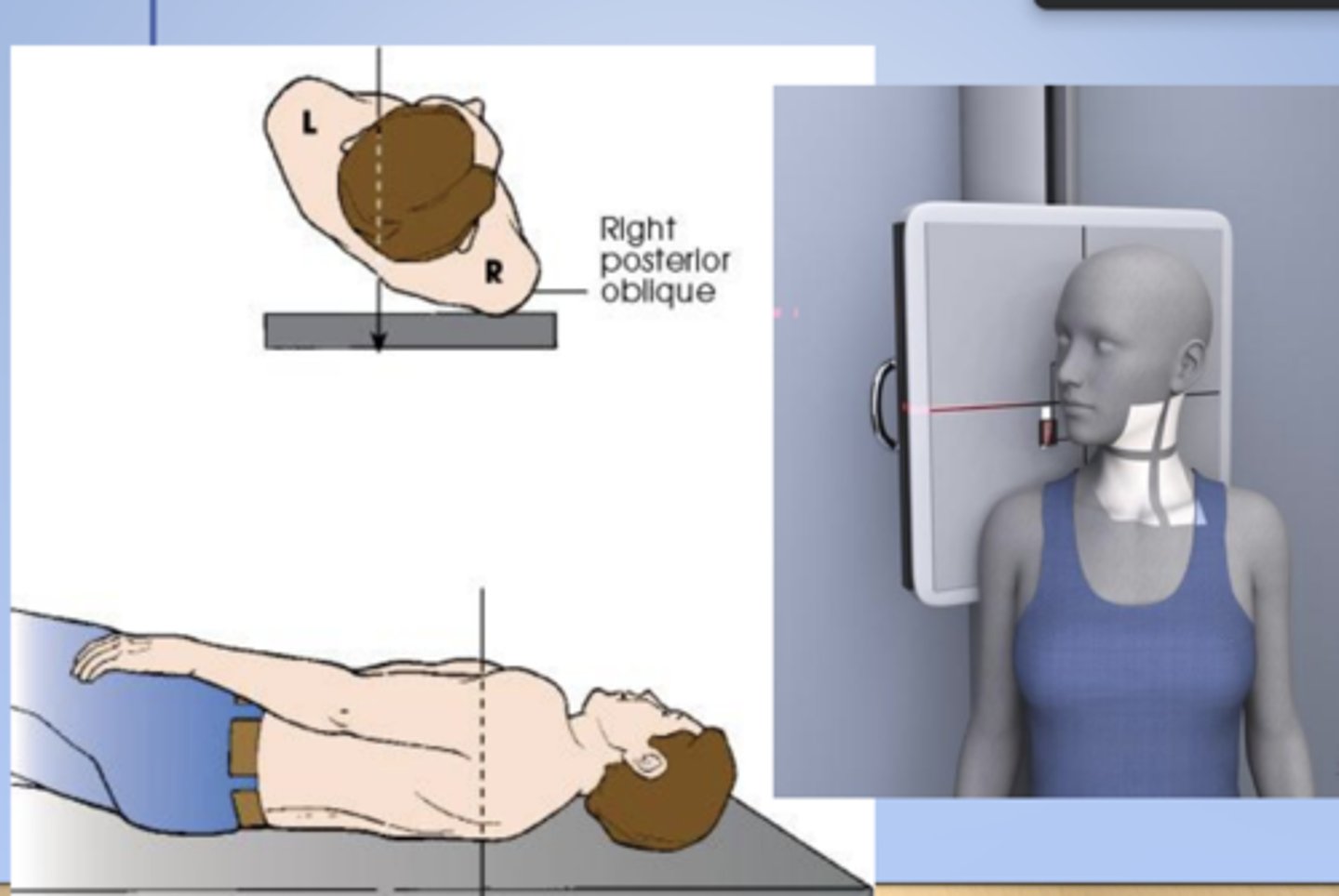 <p>X radiographic position of chest results in AP oblique projection.</p>