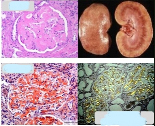 <p>What condition is shown ? When examining a tissue biopsy for this condition, what stains or methods are typically used? Describe what is seen with each stain or method mentioned.</p>