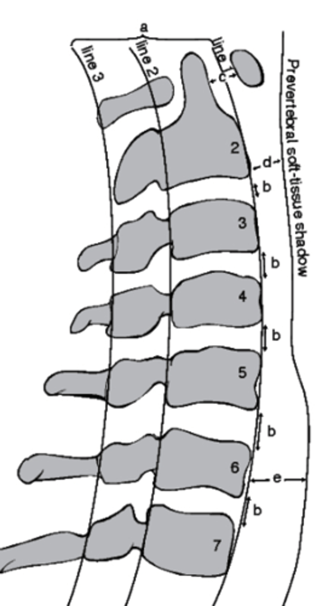 <p>which structure corresponds with the retropharyngeal space?</p><p>a. Line 1</p><p>b. D</p><p>c. Line 3</p><p>d. E</p>