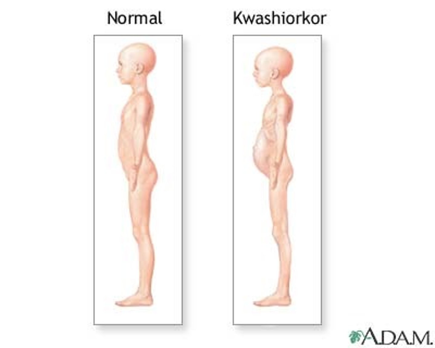 <p>Disease resulting from loss of appetite and swelling of abdomen due to lack of protein</p>