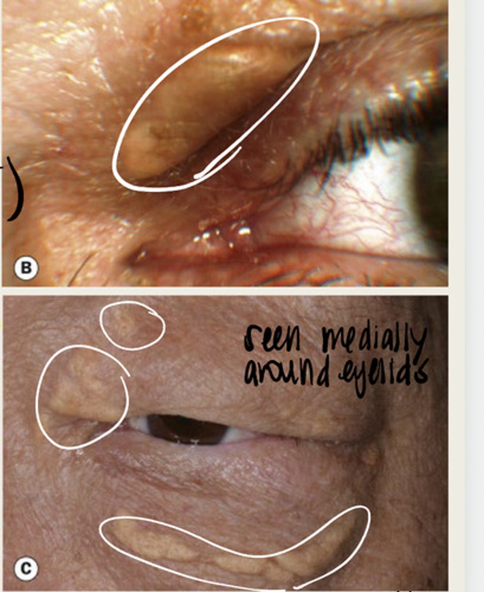 <p>Would you expect to see a xanthelasma in a 20 year old patient? What would you do if you saw this condition?</p>