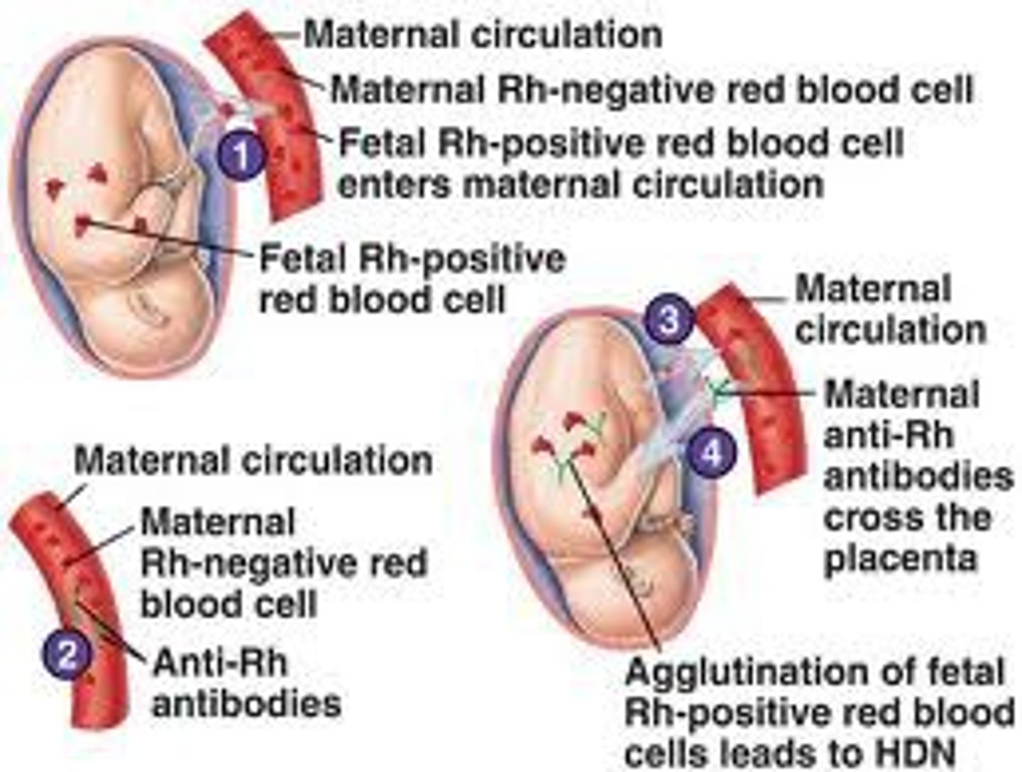 <p>a disorder that results from the incompatibility of a fetus with Rh-positive blood and a mother with Rh-negative blood, causing red blood cell destruction in the fetus; a blood transfusion is necessary to save the fetus, occurs after the mom first gives birth to an Rh+ baby (problem with subsequent pregnancies)</p>
