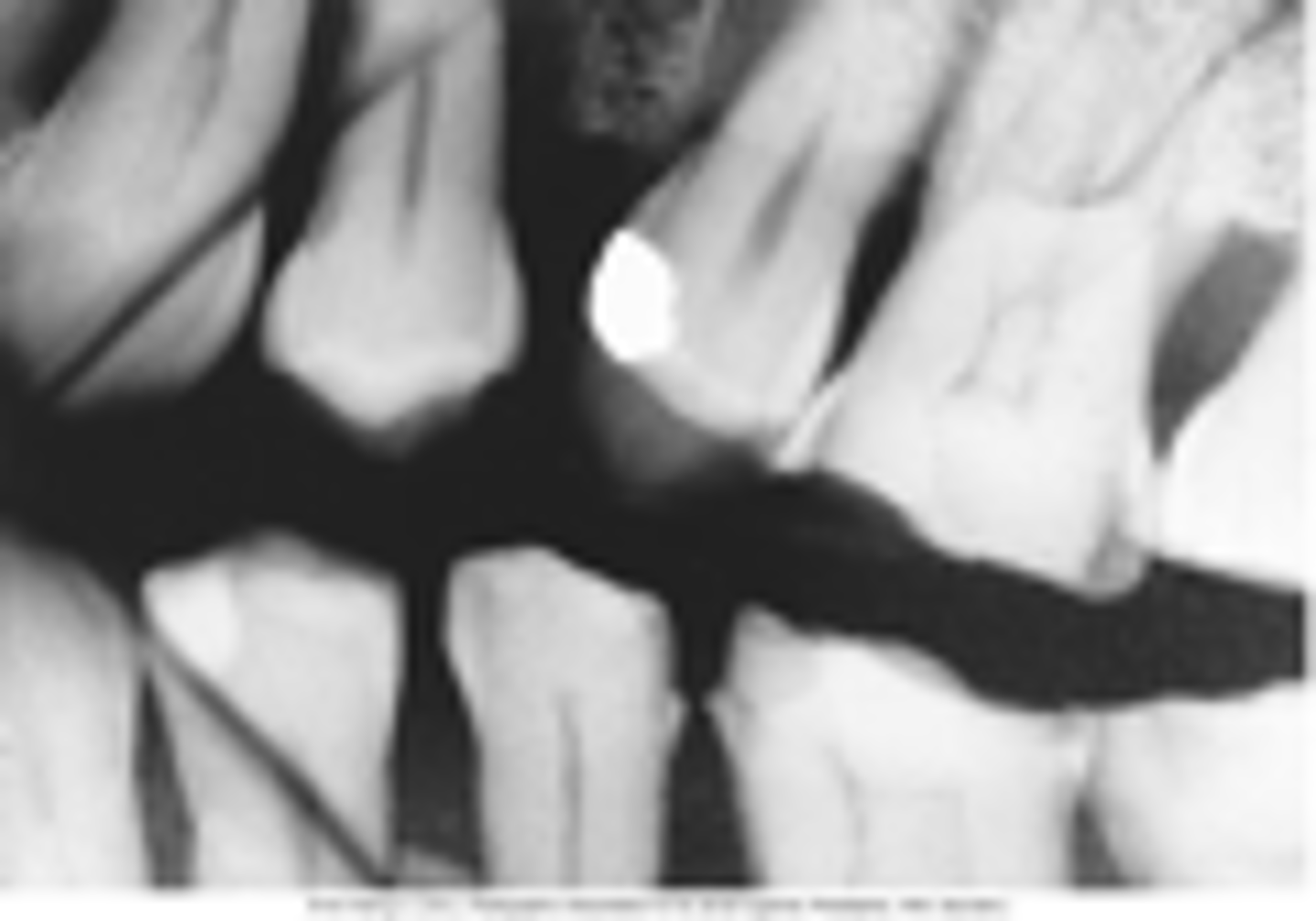 <p>occurs with paralleling, bisecting, or BWX</p><p>thin radiolucent line with film</p><p>thin white line with PSP digital receptor</p><p>do not over manipulate the receptor</p>