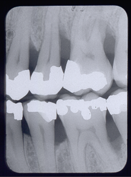 <p>T/F vertical bone loss at #19 mesial </p>