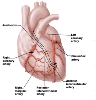 <p>Runs within the posterior interventricular sulcus</p><p>Forms anastomosis with both left branches</p>