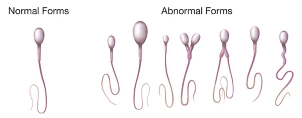 <p>abormal forms - globozoospermia </p>