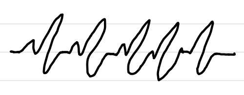 <ul><li><p>rate: <span style="color: red;">>150 bpm</span></p></li><li><p>rhythm: regular</p></li><li><p>P waves: <span style="color: red;">not seen</span></p></li><li><p>PR interval: <span style="color: red;">not measurable</span></p></li><li><p>QRS complexes: <0.10 sec</p></li><li><p>ST segments: <span style="color: red;">not seen</span></p></li></ul><p></p>