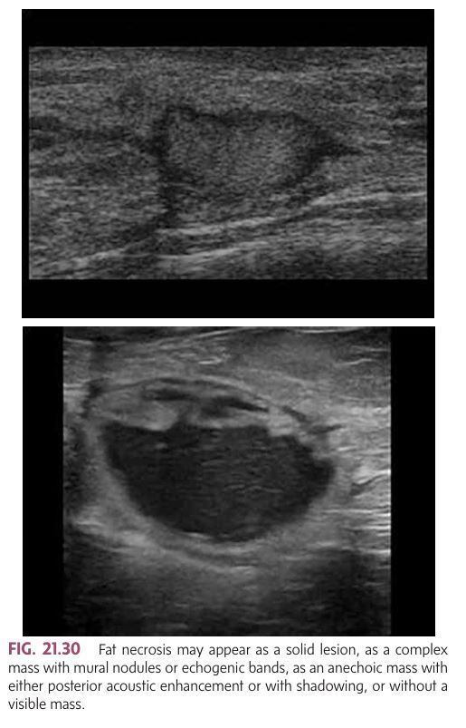 <p>Injury to breast fat may cause a common benign inflammatory process.</p><ul><li><p class=""><strong>Cause</strong>: Trauma, surgery, radiation, or inflammatory conditions (e.g., plasma cell mastitis, cancer).</p></li><li><p class=""><strong><mark data-color="yellow" style="background-color: yellow; color: inherit">More common in older women</mark></strong><mark data-color="yellow" style="background-color: yellow; color: inherit">.</mark></p></li><li><p class=""><strong>Clinical Appearance</strong>: Spherical, superficial nodule that may have <strong>calcified necrosis</strong>.</p></li><li><p class=""><strong>Deep Fat Necrosis</strong>: May cause skin retraction and mimic <strong>breast carcinoma</strong>.</p></li><li><p class=""><strong>Benign Characteristics</strong>:</p><ul><li><p class="">Limited mobility or may "roll away" when palpated.</p></li><li><p class="">Compression with ultrasound transducer may change its shape (suggesting benign nature).</p></li></ul></li></ul><p><strong>Sonographic Appearance of Fat Necrosis</strong>:</p><ul><li><p class=""><strong>Varied appearance</strong>:</p><ol><li><p class="">Solid lesion.</p></li><li><p class="">Complex mass with <strong>mural nodules</strong> or <strong>echogenic bands</strong>.</p></li><li><p class="">Anechoic mass (may show <strong>posterior acoustic enhancement</strong> or <strong>shadowing</strong>).</p></li><li><p class="">May not show a visible mass.</p></li></ol><p class="">Despite its variable appearance, <strong>fat necrosis</strong> is distinct from the rest of the breast tissue and usually benign.</p></li></ul><p></p>