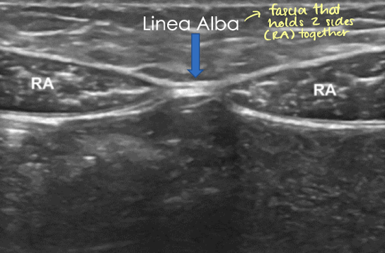 <ul><li><p><strong>hypoechoic</strong> with <strong>echogenic striations in LONG </strong></p></li><li><p>right and left rectus abdominis muscles<strong> join linea alba</strong> (echogenic) which courses along abdominal midline </p></li></ul><p></p>