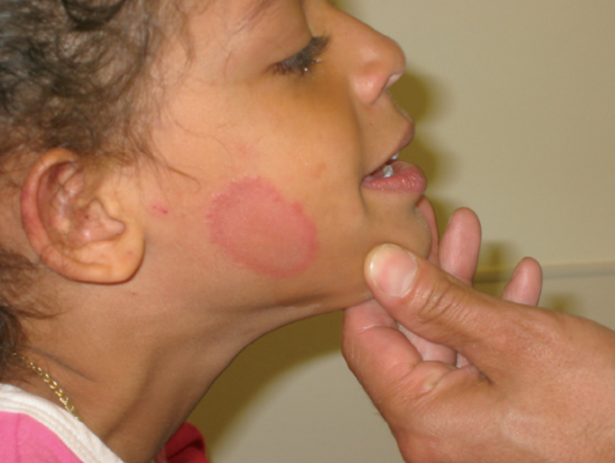 <ul><li><p><strong>Fungal Infection</strong>:</p><ul><li><p>Affects any part of the body.</p></li><li><p>“Ringworm”—type of dermatophytosis…</p></li><li><p>Annular lesion with raised peripheral scaling and central clearing (looks like a ring!)</p></li></ul></li></ul><p></p>