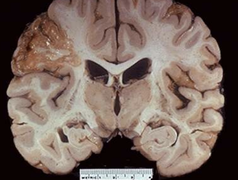 <p>Brain Infarct</p>