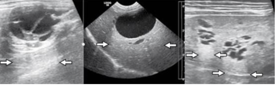 <ul><li><p>increased echogenicty of tissue deep to an area or structure </p></li><li><p>often seen deep to fluid filled structures</p></li></ul><p></p>