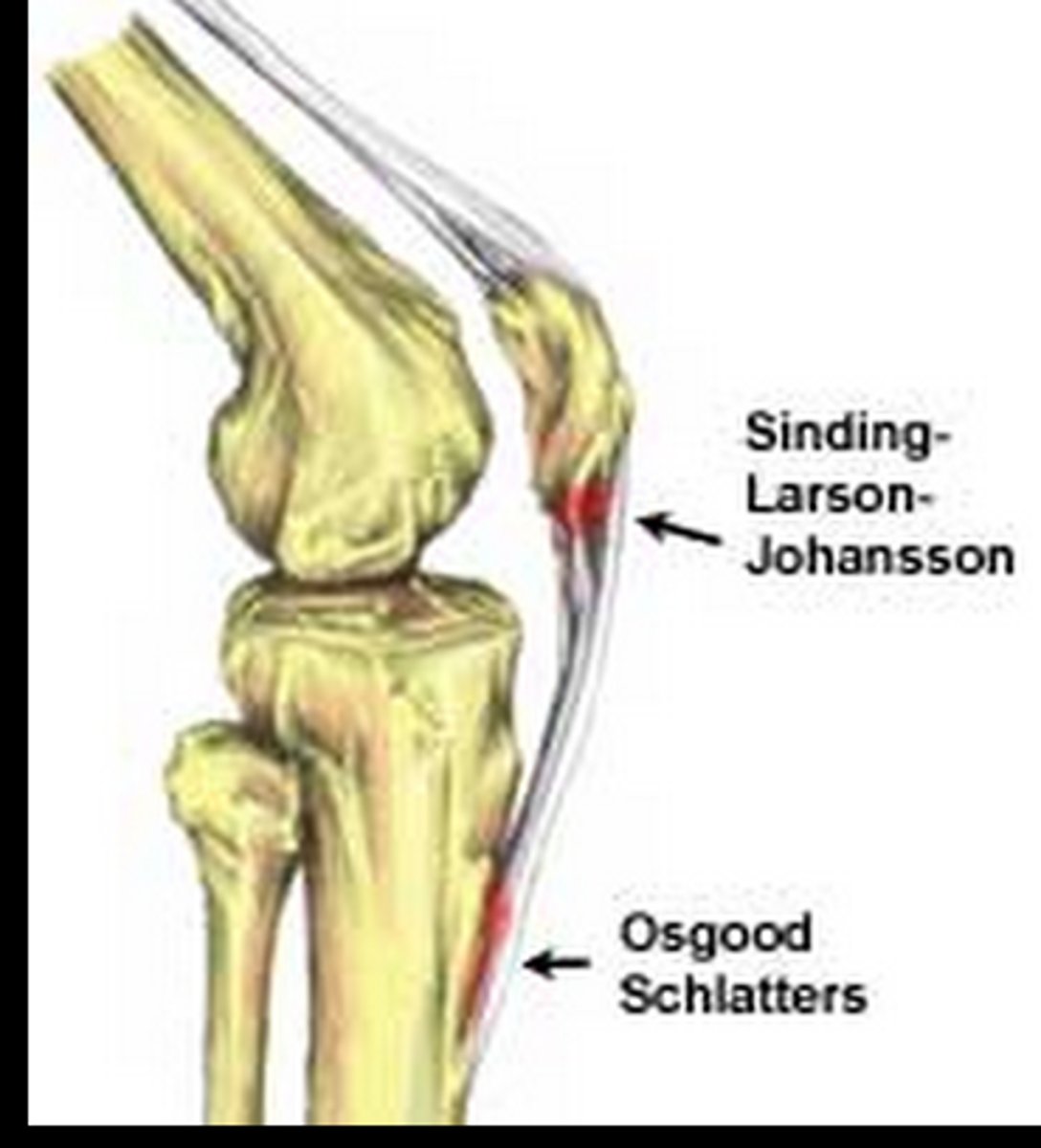 <p>traction apophysitis of the inferior pole of the patella</p><p>pain with activities such as cycling, athletics, resisted knee extension</p><p>test: xray fragmentation of tibial tubercle or irregular calcification</p>