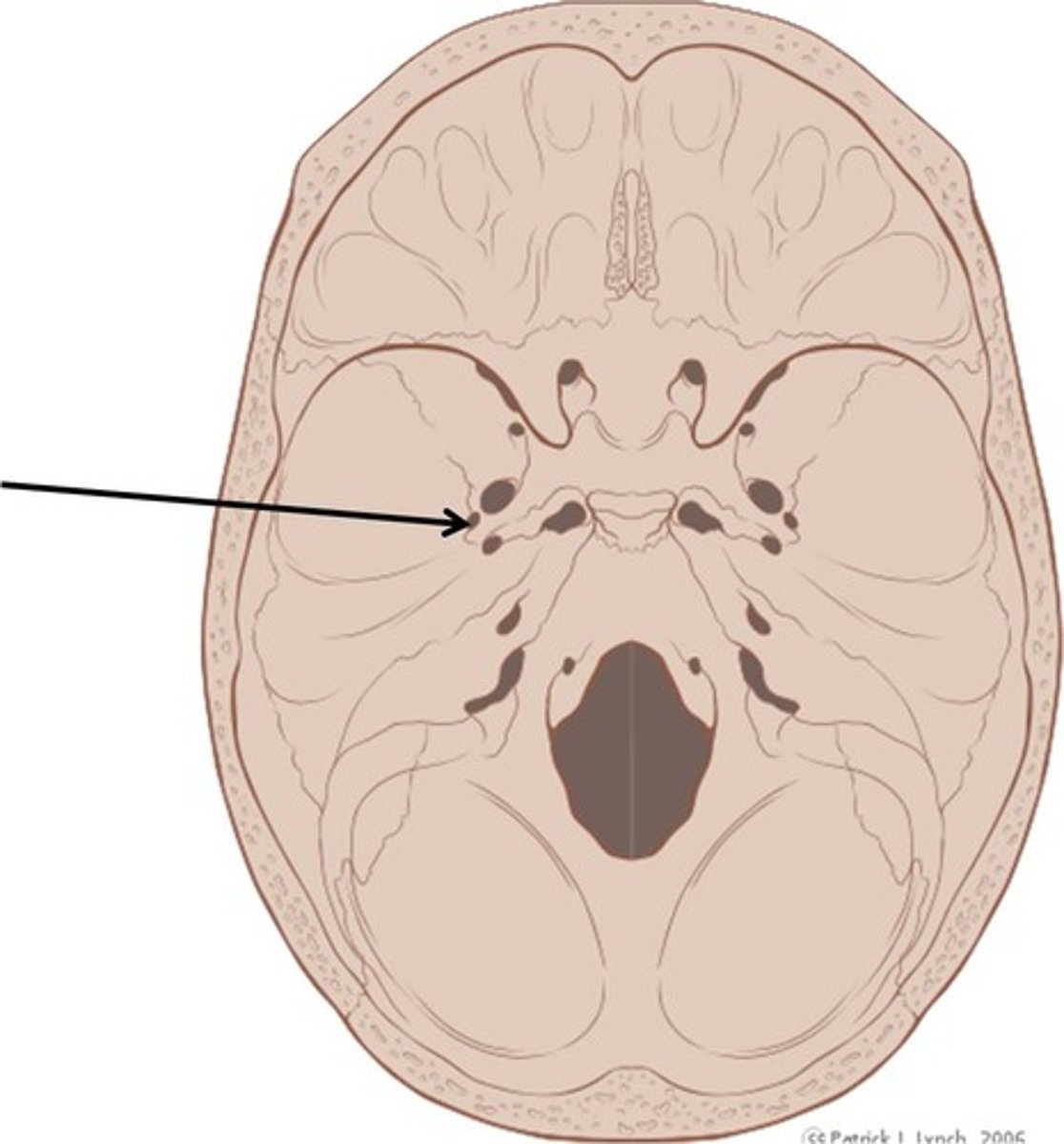 <p>(Sphenoid)</p><p>Openings located posterolateral to the foramen spinosum; provides passageway for the middle meningeal artery</p>