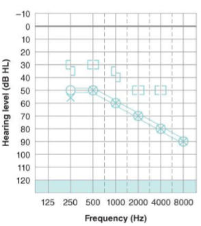 <p>What type of hearing loss is this and describe the results?</p>