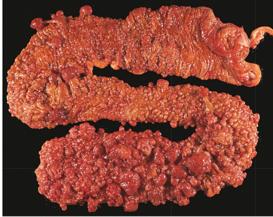 A 19-year-old man is advised to see his physician because genetic screening has detected the disease in other family members. On physical examination, a stool sample is positive for occult blood. A colonoscopy is performed, followed by a colectomy. The figure shows the gross appearance of the mucosal surface of the colectomy specimen. Microscopic examination shows these lesions are tubular adenomas. The diagnosis of the condition is?