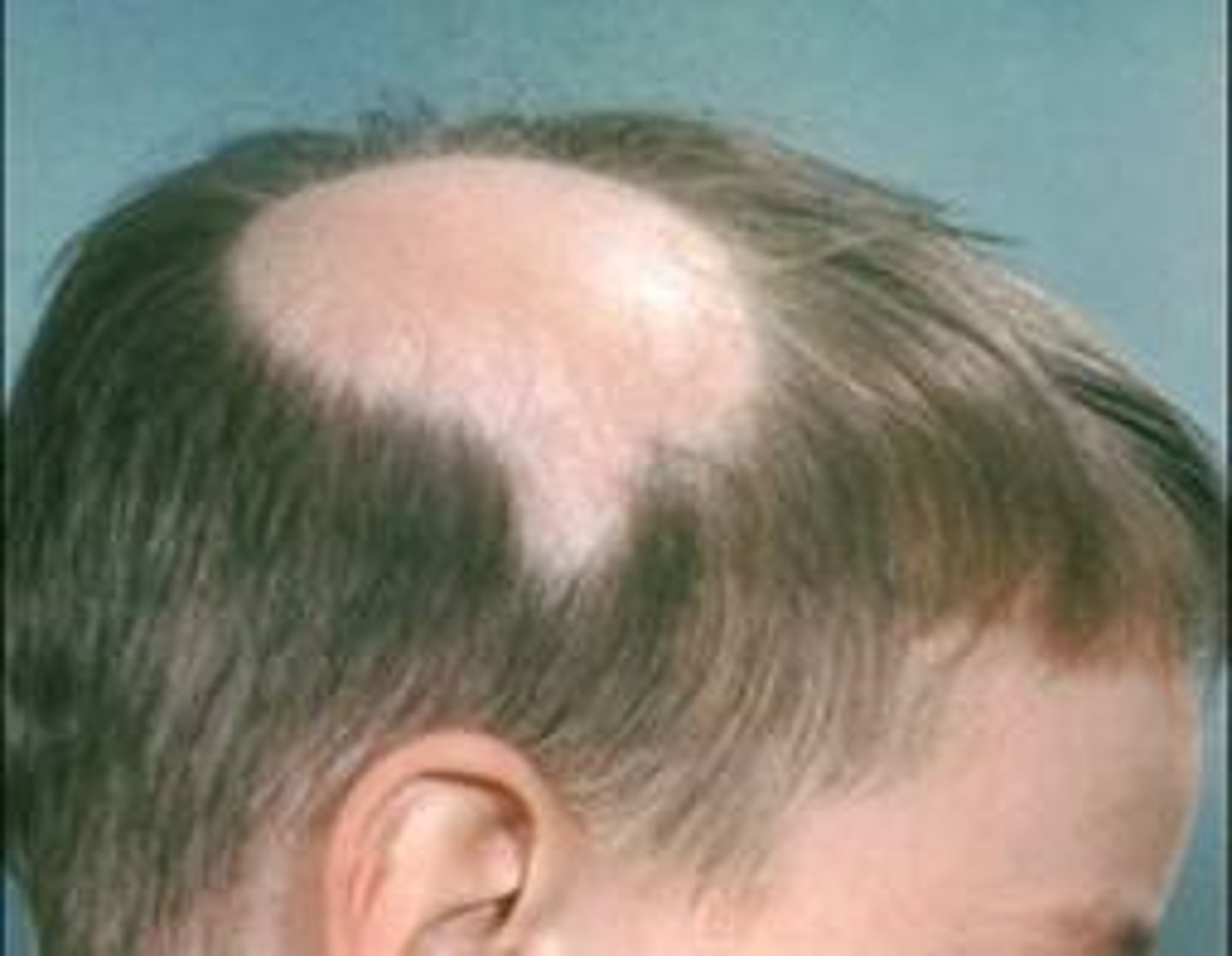 <p>autoimmune disease that results in the loss of hair</p>