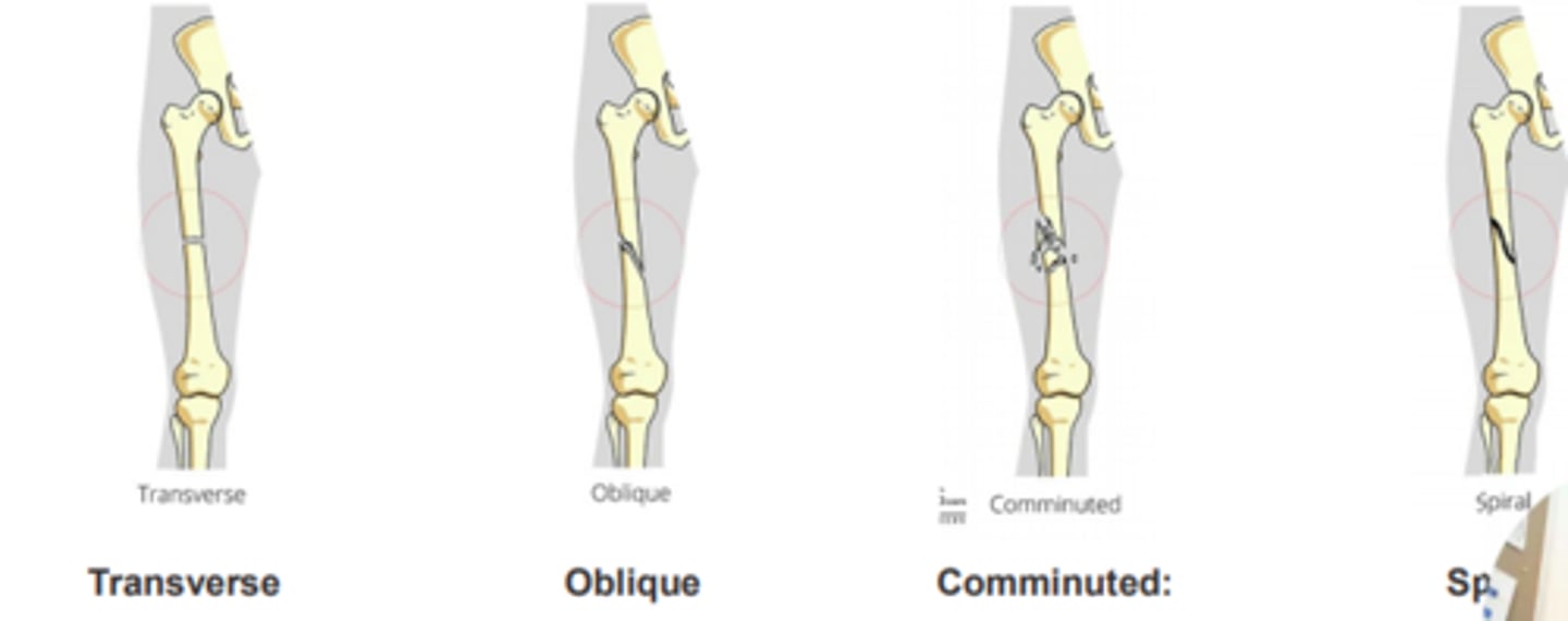 <p>Transverse </p><p>- Straight across the bone</p><p>Oblique</p><p>- Oblique line across the bone</p><p>Comminuted</p><p>- More than 2 parts to the fracture</p><p>Spiral </p><p>- Twisting motion</p><p>- Fracture like looks like a corkscrew </p>