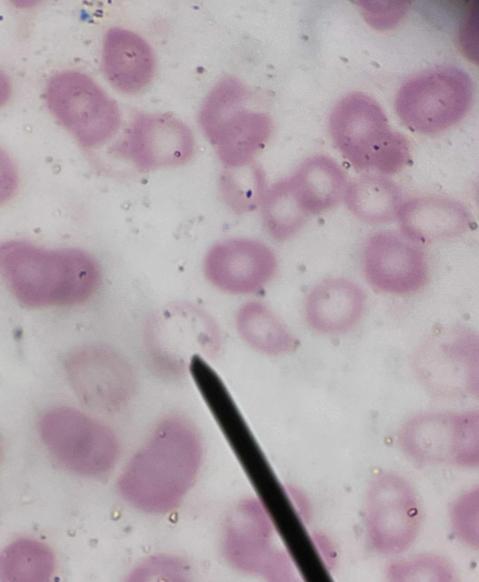<p>A. Identify the pointed cell</p><p>B. Describe the striking feature</p><p>C. Increased number of this cell in the peripheral smear is termed as?</p><p>D. Give associated condition</p>
