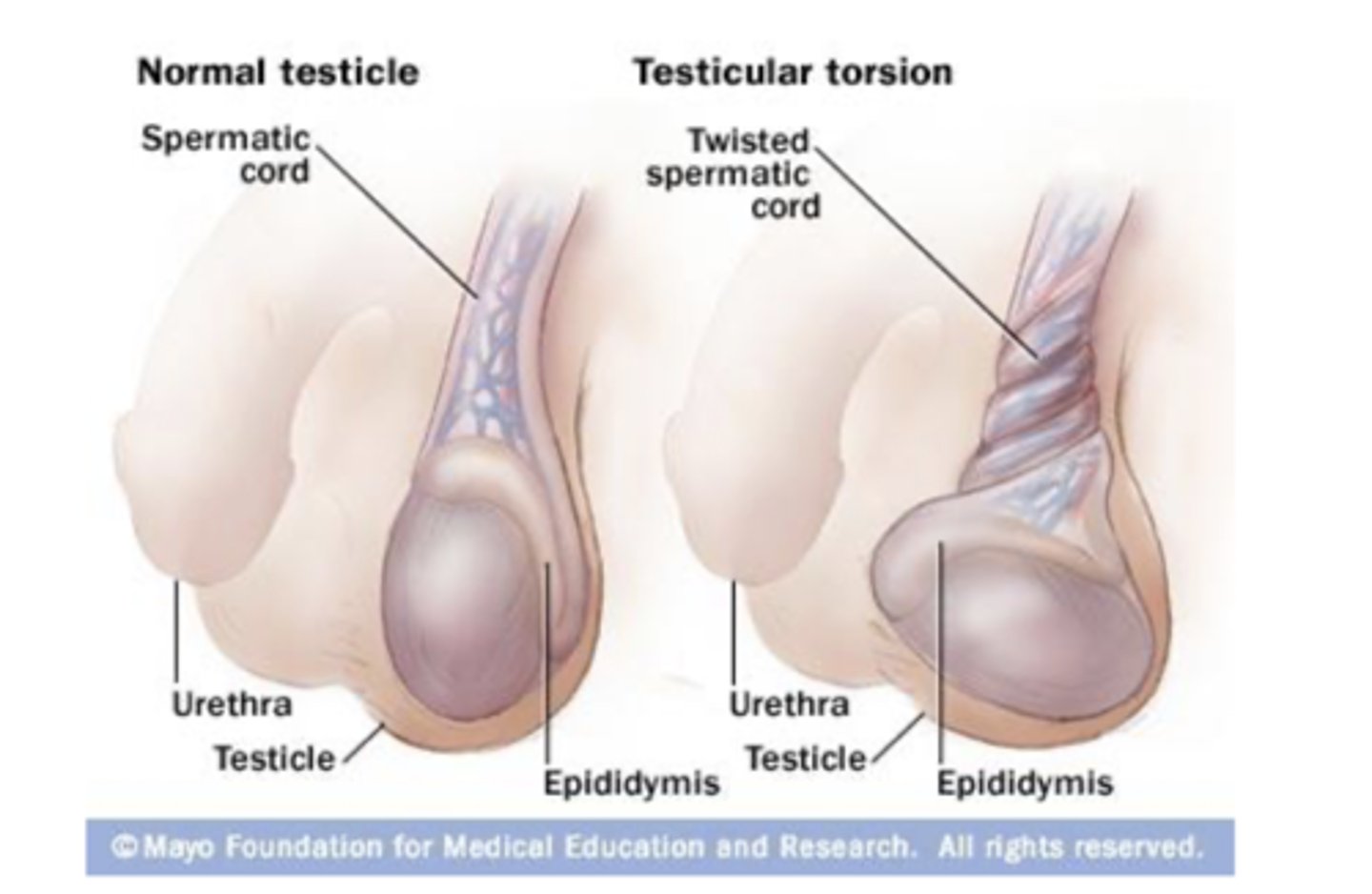 <p>testes rotate on the spermatic cord, compressing arteries and veins - causes ischemia or infarction. most cases occur in adolescence and must be treated like an emergency. can be spontaneous or due to injury</p>