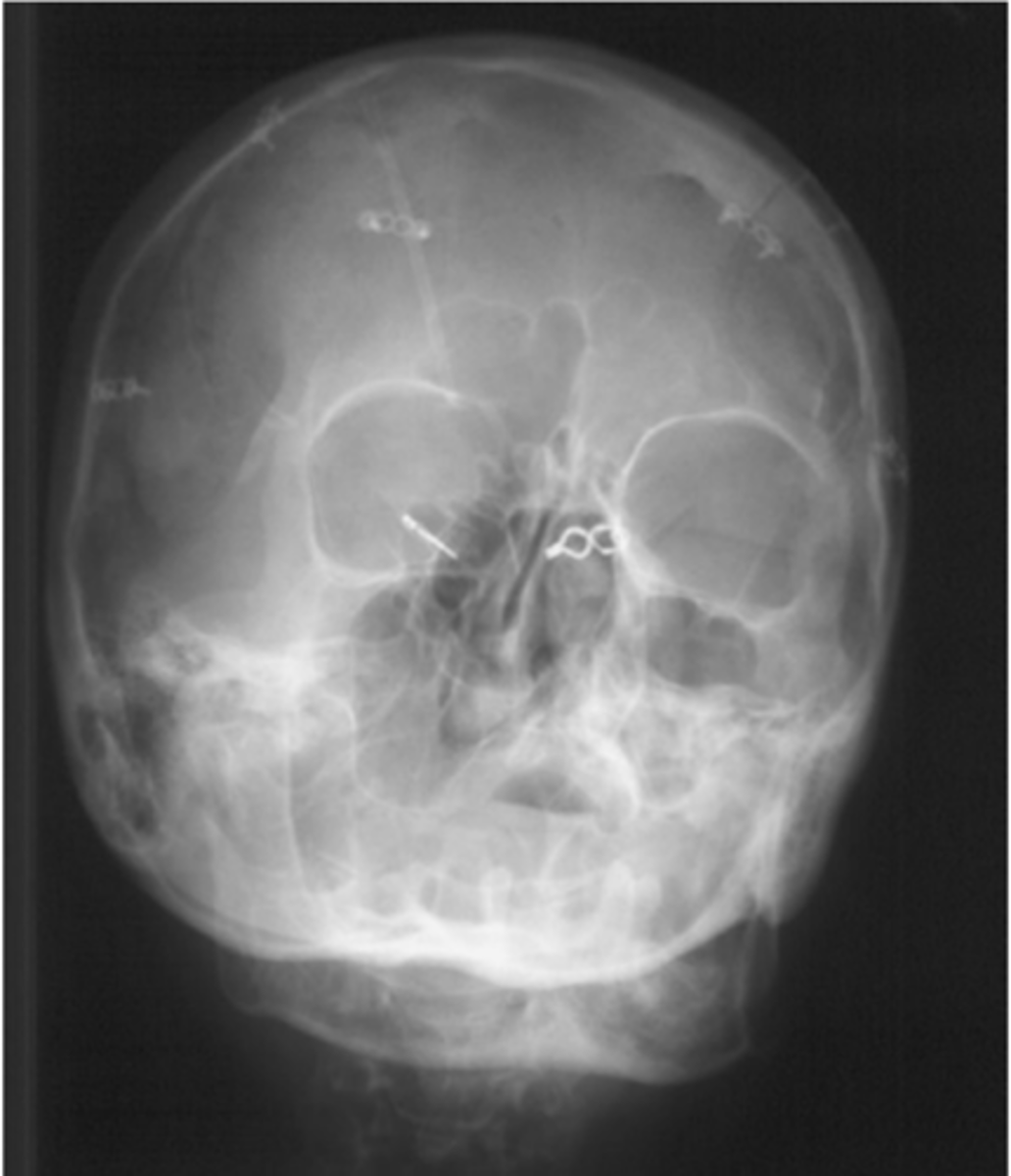 <p>Repeatable errors (three)—</p><p>Criterion 1: Anatomy demonstrated: Maxillary sinuses are not well demonstrated. Petrous ridges are projected into the lower aspect of maxillary sinuses. Artifacts appear to be both surgical clips and devices (acceptable) and external hair pins and clips (not acceptable). </p><p>Criterion 2: Positioning: The skull is underextended and severely rotated. This results in projection of petrous ridges into the lower aspect of the maxillary sinuses. Artifacts appear to be external hair pins or clips</p><p>Criterion 5: Anatomic side markers: No anatomic side marker is visible.</p>