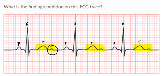 <p>JONES IN CLASS ASSIGNMENT QUESTIONS:</p><p>a. hypokalemia</p><p>b. second degree heart block</p><p>c. bundle branch block</p><p>d. hypocalcemia</p>